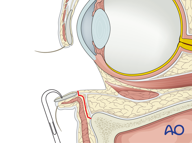 Inferior fornix transconjunctival