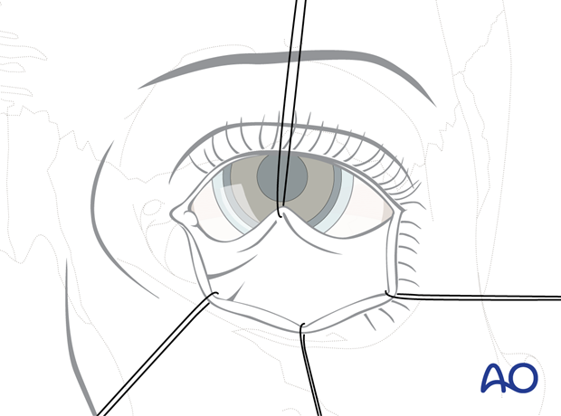 Inferior fornix transconjunctival