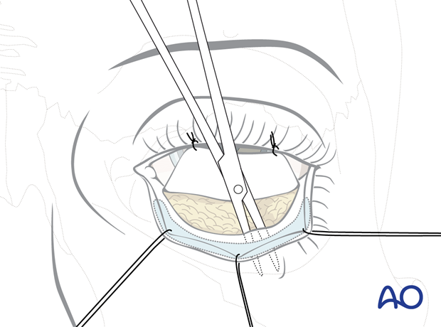 Inferior fornix transconjunctival