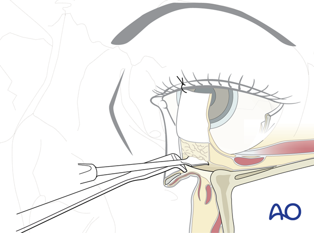 Inferior fornix transconjunctival