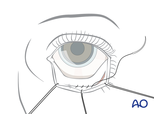 Inferior fornix transconjunctival