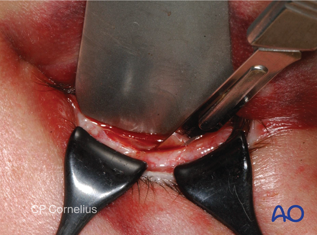 Inferior fornix transconjunctival