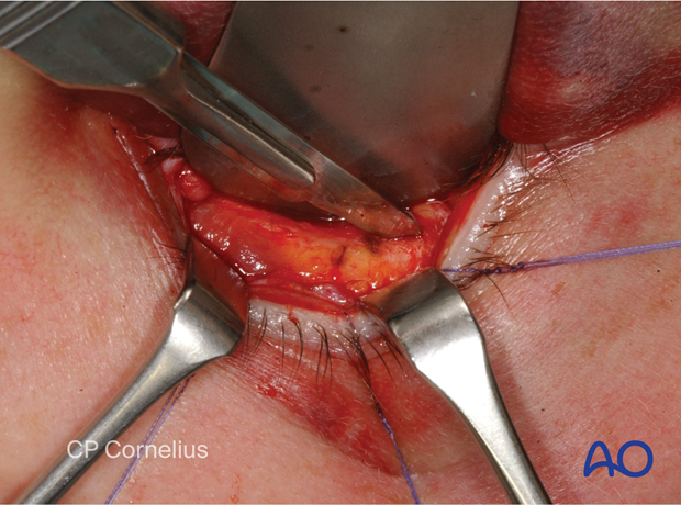 Inferior fornix transconjunctival