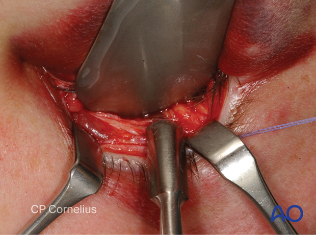 Inferior fornix transconjunctival