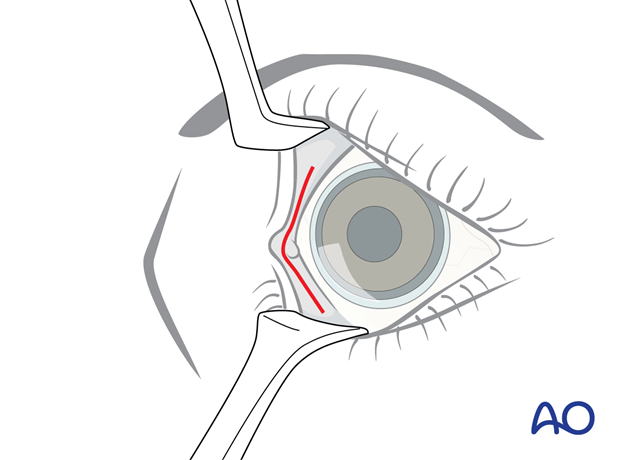 Pre-/Transcaruncular approach