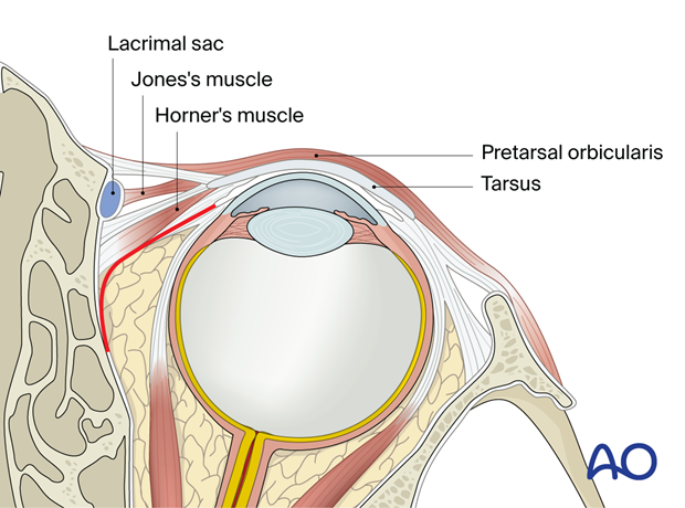 Pre-/Transcaruncular approach