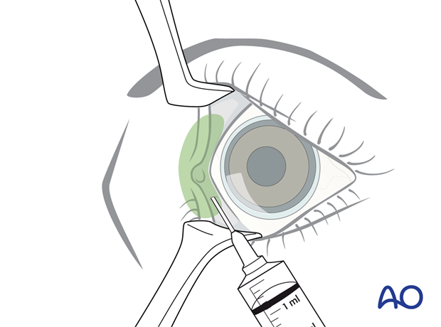 Pre-/Transcaruncular approach