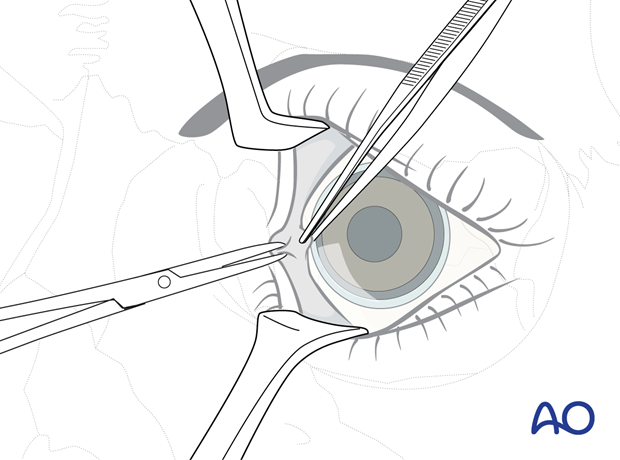 Pre-/Transcaruncular approach