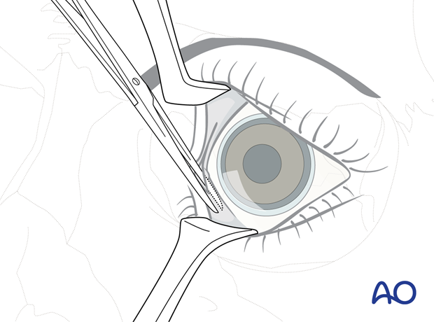 Pre-/Transcaruncular approach