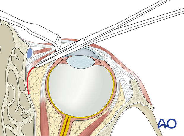 Pre-/Transcaruncular approach