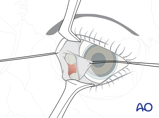 Pre-/Transcaruncular approach