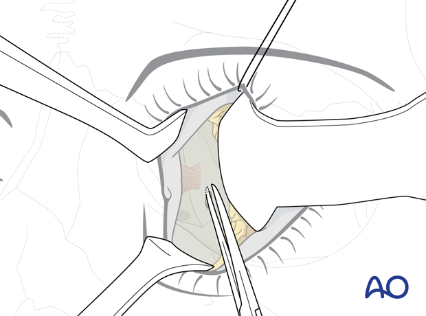 Pre-/Transcaruncular approach