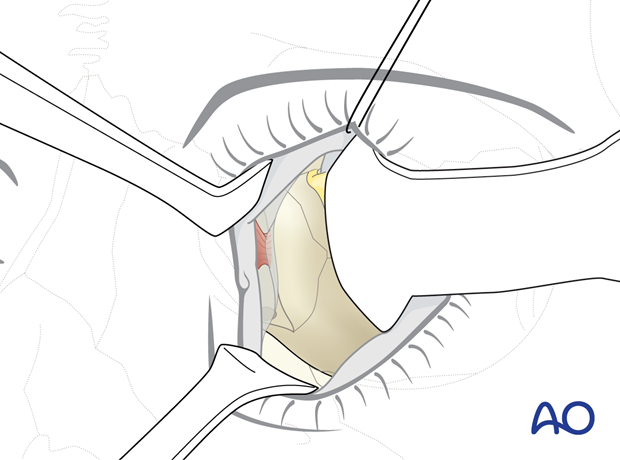 Pre-/Transcaruncular approach