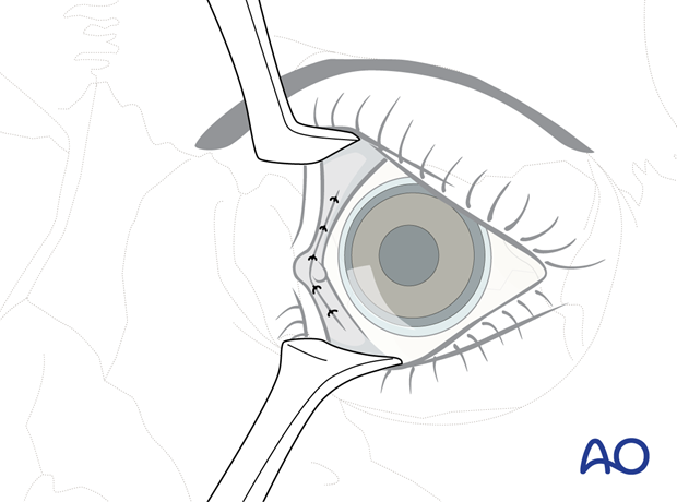 Pre-/Transcaruncular approach