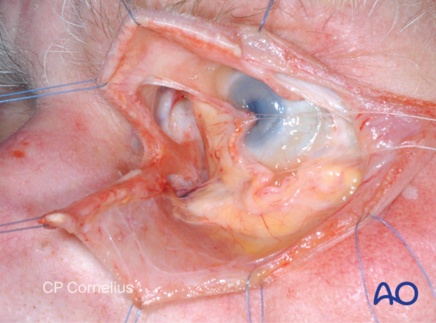 Pre-/Transcaruncular approach