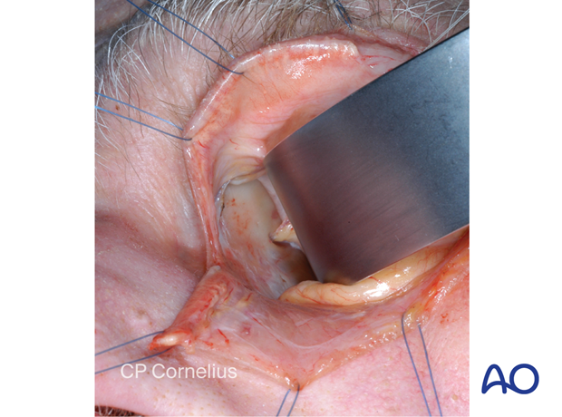 Pre-/Transcaruncular approach