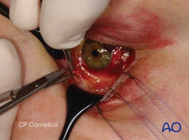 Pre-/Transcaruncular approach