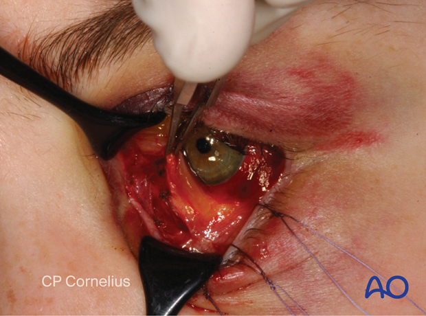 Pre-/Transcaruncular approach