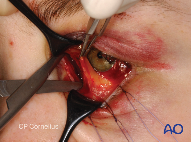 Pre-/Transcaruncular approach