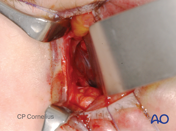 Pre-/Transcaruncular approach