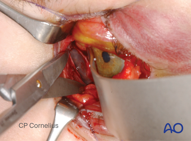 Pre-/Transcaruncular approach