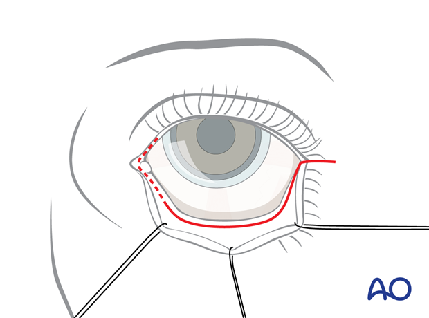 Transconjunctival approach with lateral skin extension