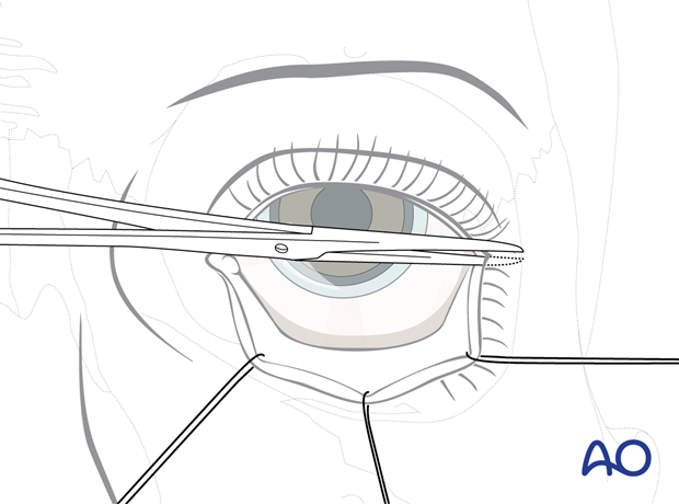 Transconjunctival approach with lateral skin extension