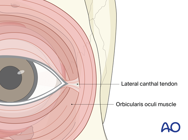 Transconjunctival approach with lateral skin extension