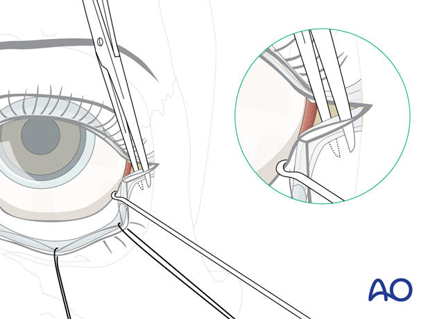 Transconjunctival approach with lateral skin extension