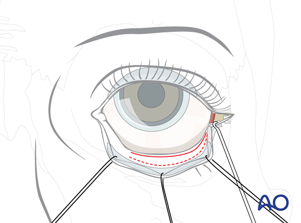 Transconjunctival approach with lateral skin extension