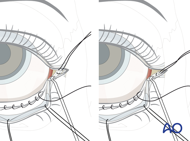 Transconjunctival approach with lateral skin extension