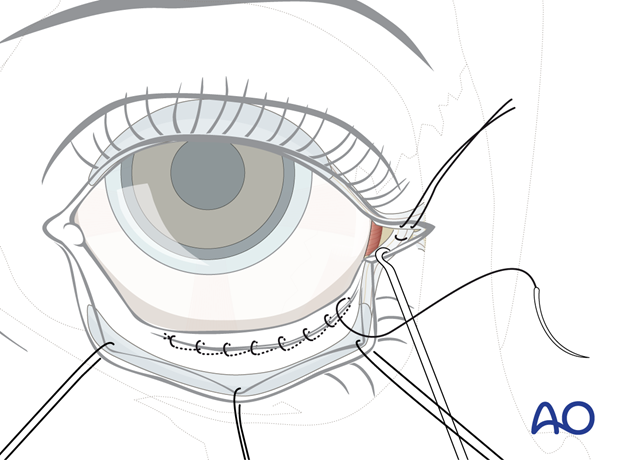 Transconjunctival approach with lateral skin extension