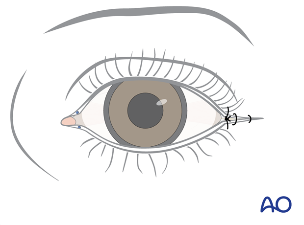 Transconjunctival approach with lateral skin extension