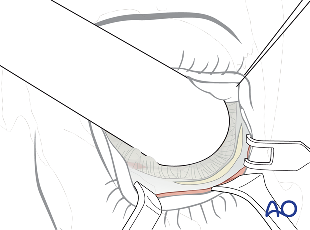 Transconjunctival approach with lateral skin extension