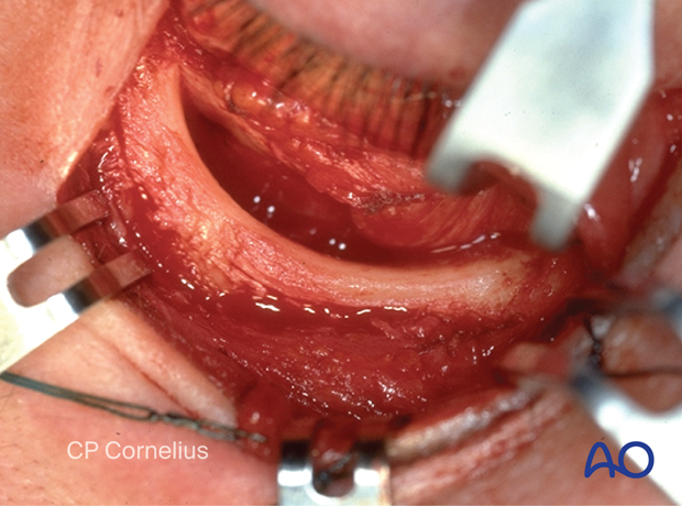 Transconjunctival approach with lateral skin extension