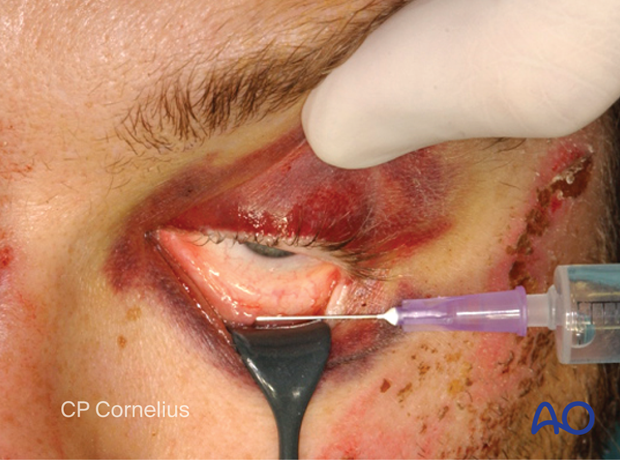 Transconjunctival approach with lateral skin extension