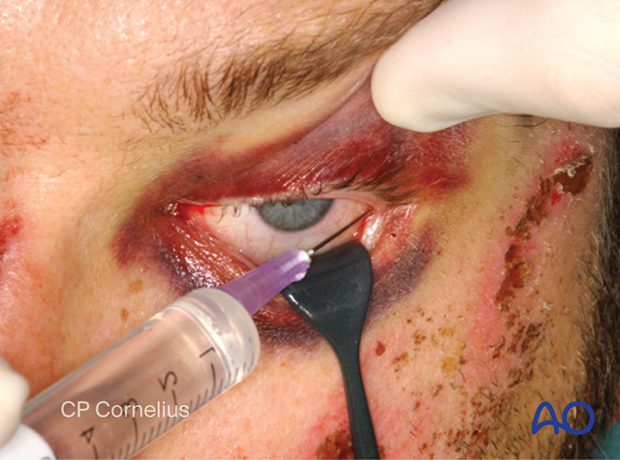 Transconjunctival approach with lateral skin extension