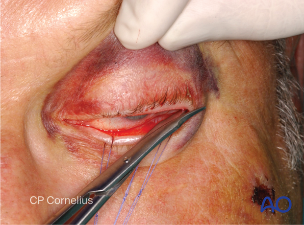 Transconjunctival approach with lateral skin extension