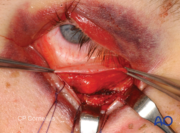 Transconjunctival approach with lateral skin extension