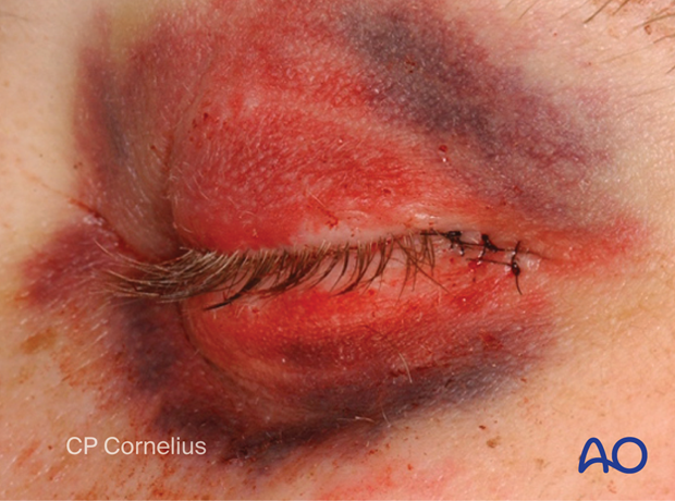 Transconjunctival approach with lateral skin extension