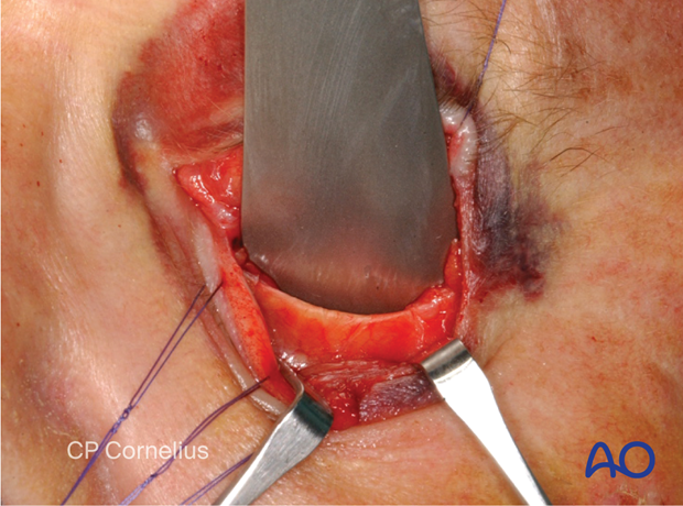 Transconjunctival approach with lateral skin extension