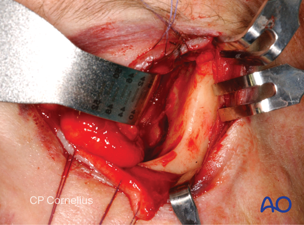 Transconjunctival approach with lateral skin extension