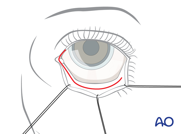 Combination of inferior and medial transconjunctival