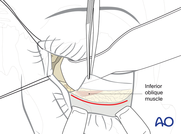 Combination of inferior and medial transconjunctival