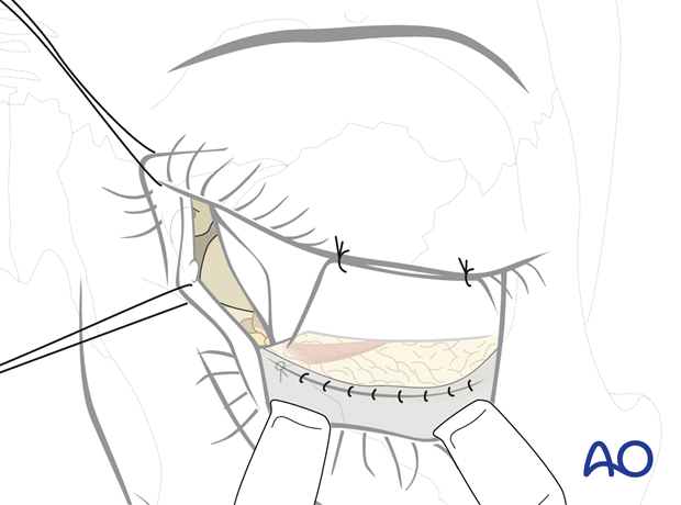 Combination of inferior and medial transconjunctival