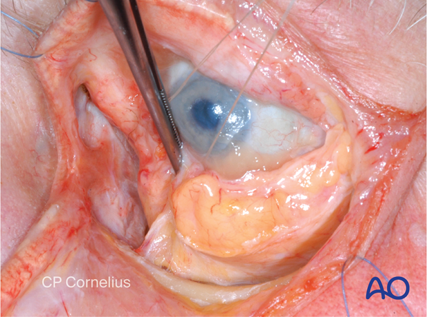 Combination of inferior and medial transconjunctival