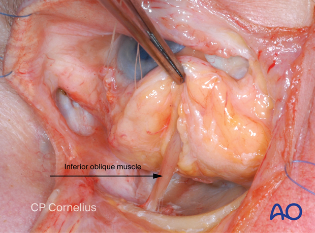 Combination of inferior and medial transconjunctival