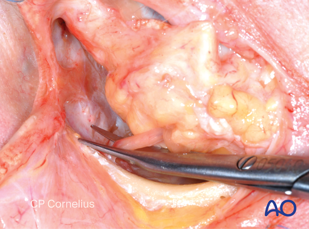 Combination of inferior and medial transconjunctival