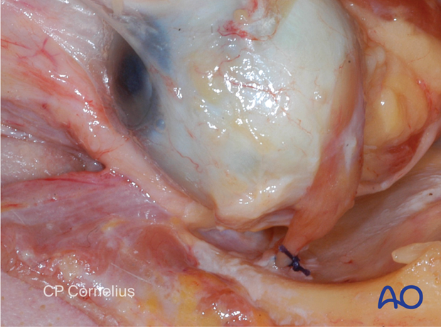 Combination of inferior and medial transconjunctival