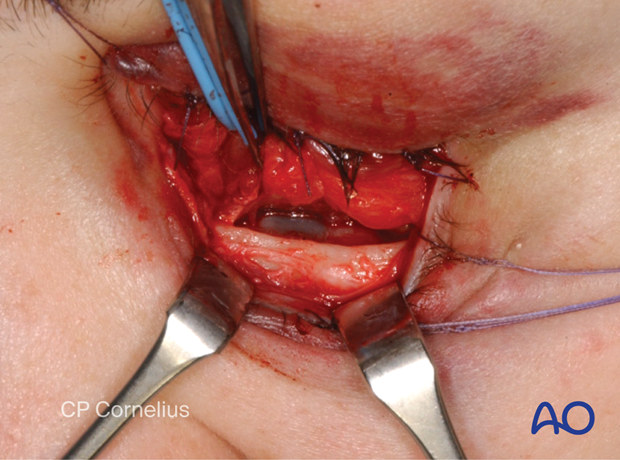 Combination of inferior and medial transconjunctival